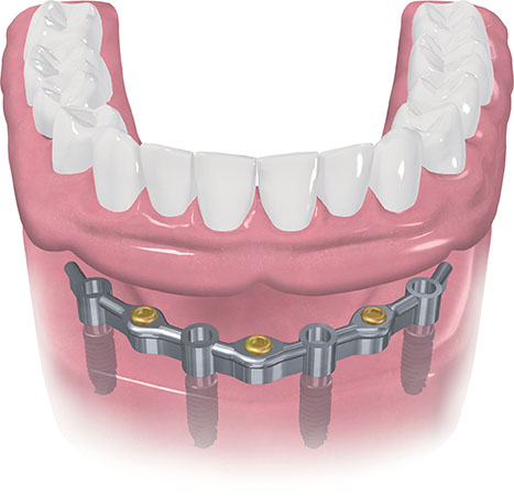 Dental Implants