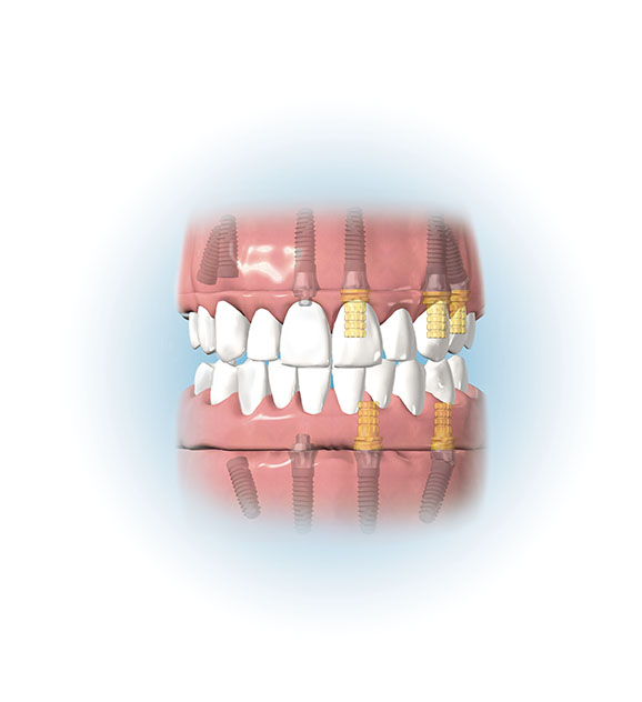 Dental Implants