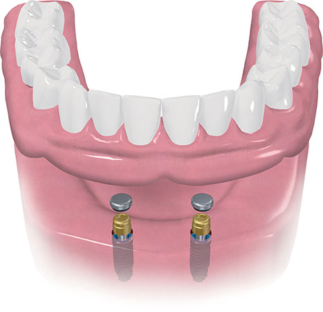 Dental Implants