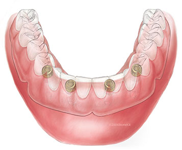 Dental Implants