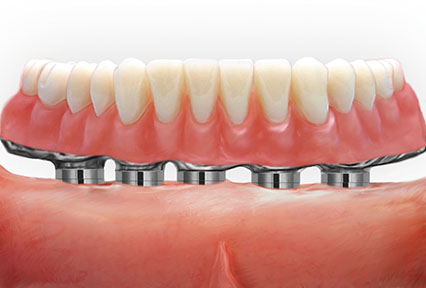 Dental Implants