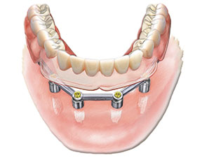 Dental Implants