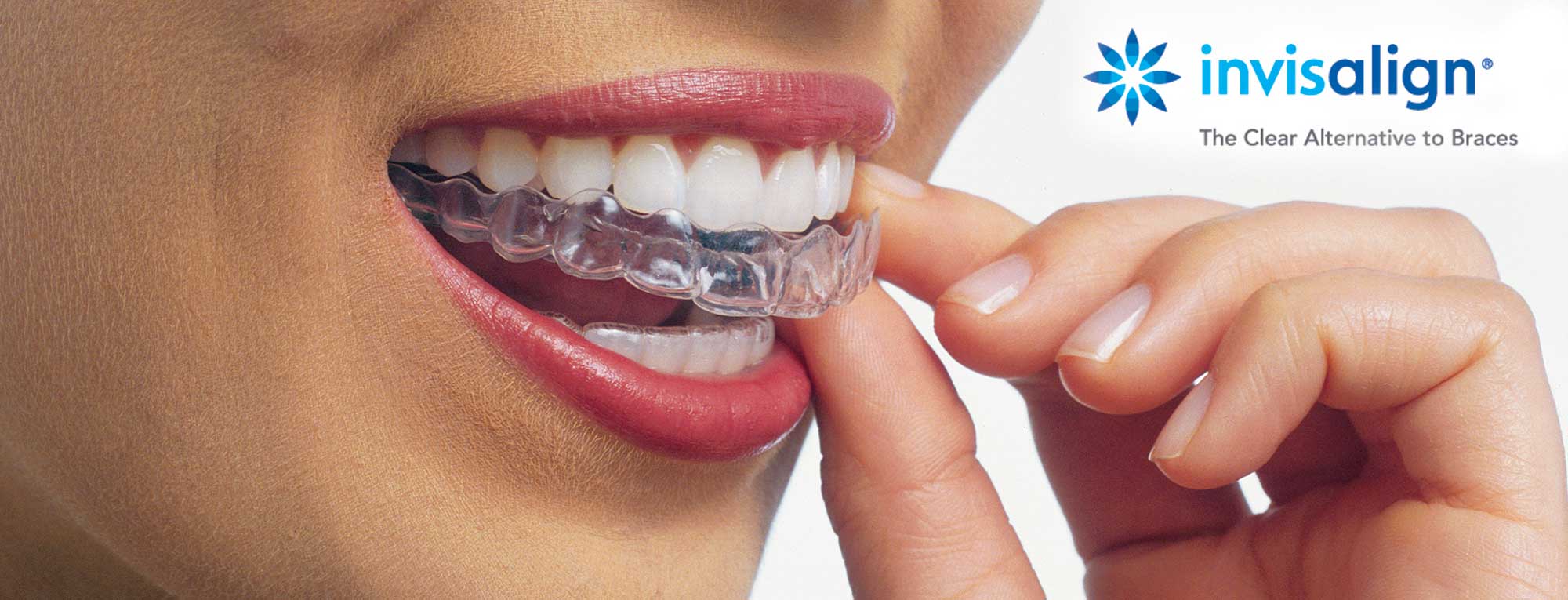 Invisalign